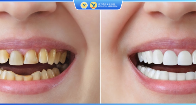 Bảng giá dịch vụ tẩy trắng răng